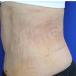 Liposuction Before & After Patient #871