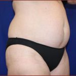 Liposuction Before & After Patient #852