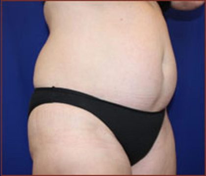 Liposuction Before & After Patient #852