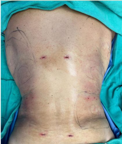 Liposuction Before & After Patient #873