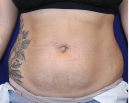 Liposuction Before & After Patient #876