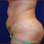 Liposuction Before & After Patient #853