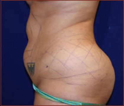 Liposuction Before & After Patient #853