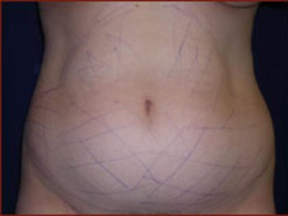 Liposuction Before & After Patient #854