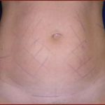 Liposuction Before & After Patient #855