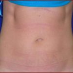 Liposuction Before & After Patient #855