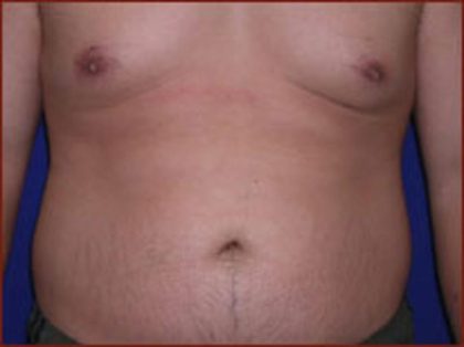Liposuction Before & After Patient #858