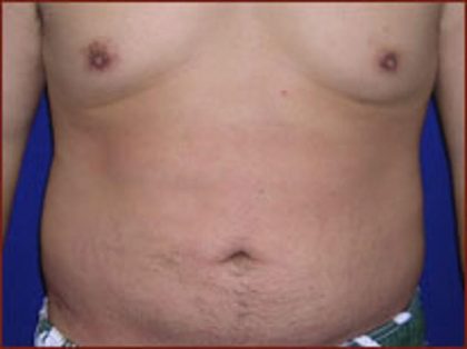 Liposuction Before & After Patient #858