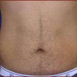 Liposuction Before & After Patient #860
