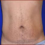 Liposuction Before & After Patient #860