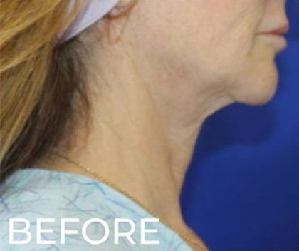Neck Lift Before & After Patient #957