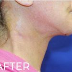 Neck Lift Before & After Patient #957