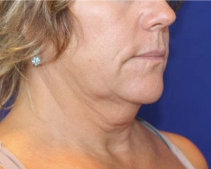 Neck Liposuction Before & After Patient #1044