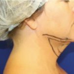 Neck Liposuction Before & After Patient #1044