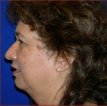 Neck Liposuction Before & After Patient #1036