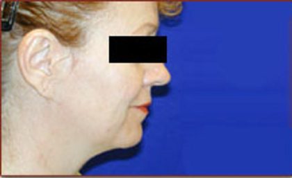 Neck Liposuction Before & After Patient #1038