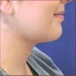 Neck Liposuction Before & After Patient #1039