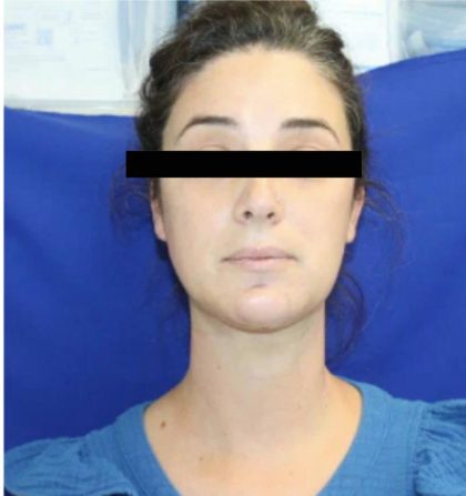 Neck Liposuction Before & After Patient #1040