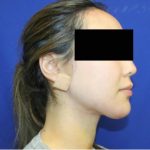 Neck Liposuction Before & After Patient #1041