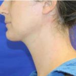 Neck Liposuction Before & After Patient #1042