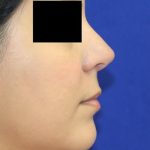 Rhinoplasty Before & After Patient #1046
