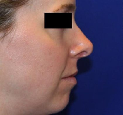Rhinoplasty Before & After Patient #1047