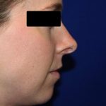 Rhinoplasty Before & After Patient #1047