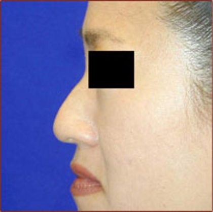 Rhinoplasty Before & After Patient #1048