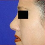Rhinoplasty Before & After Patient #1048