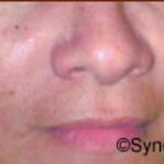 Skin Rejuvenation Before & After Patient #1228