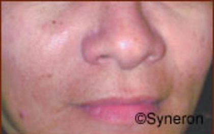 Skin Rejuvenation Before & After Patient #1228