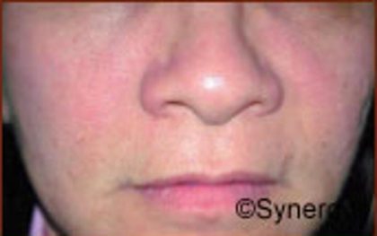 Skin Rejuvenation Before & After Patient #1228