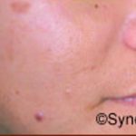 Skin Rejuvenation Before & After Patient #1228