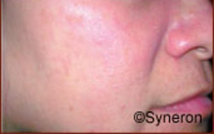 Skin Rejuvenation Before & After Patient #1228