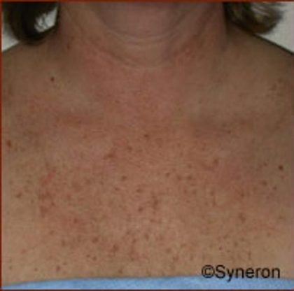 Skin Rejuvenation Before & After Patient #1229