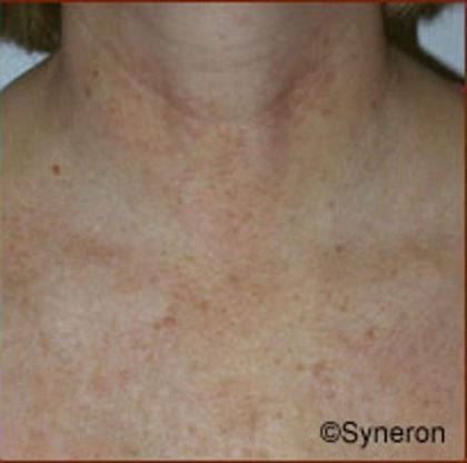 Skin Rejuvenation Before & After Patient #1229
