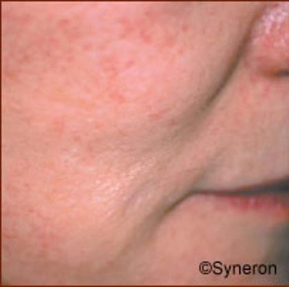 Skin Rejuvenation Before & After Patient #1230
