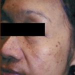 Skin Rejuvenation Before & After Patient #1233