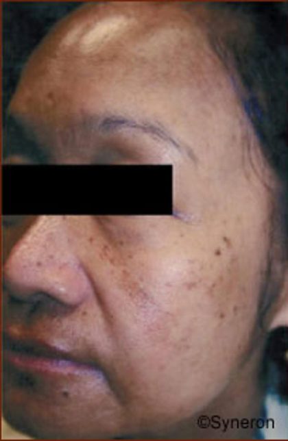 Skin Rejuvenation Before & After Patient #1233