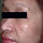 Skin Rejuvenation Before & After Patient #1233