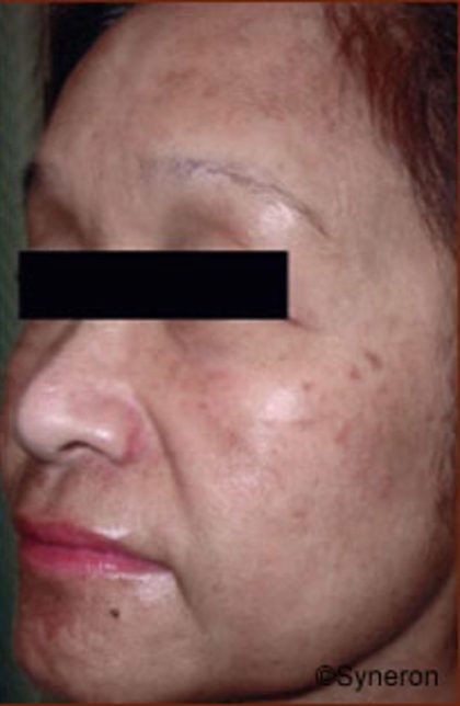 Skin Rejuvenation Before & After Patient #1233