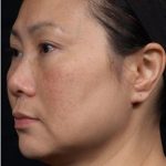 Thermage Before & After Patient #1235