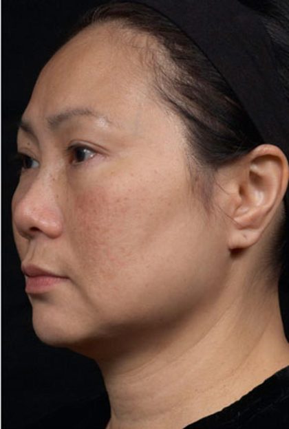 Thermage Before & After Patient #1235