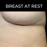 Breast Augmentation Before & After Patient #1448