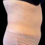Tummy Tuck Before & After Patient #1443
