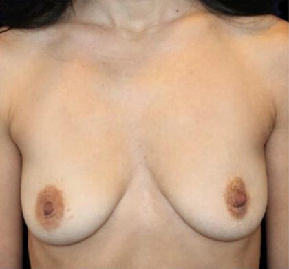 Breast Augmentation Before & After Patient #1444