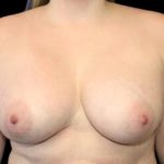 Breast Augmentation Before & After Patient #1445