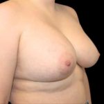 Breast Augmentation Before & After Patient #1445