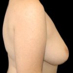 Breast Reduction Before & After Patient #1447