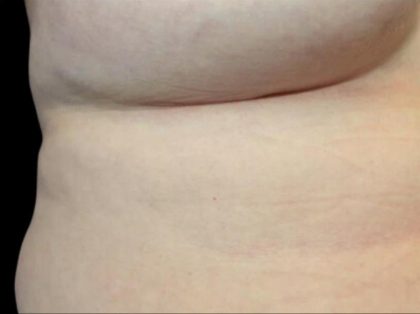 Breast Augmentation Before & After Patient #1448
